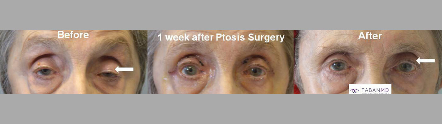 86-year-old female, with severe age-related droopy upper eyelids underwent functional droopy upper eyelid surgery. Before, 1 week after, and 1 month after eyelid ptosis repair photos are shown.