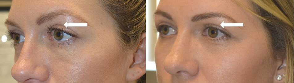 Young lady, with history of aggressive upper blepharoplasty (by another surgeon) resulting in sunken hollow upper eyelids, underwent upper eyelid filler injection. Before and 1+ year after upper eyelid filler injection photos are shown. Note the longevity of the eyelid filler treatment with improved youthful eye appearance.