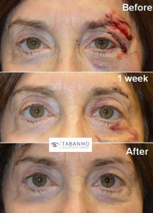 70+ year old woman, who suffered from eyelid/brow laceration from a fall, underwent repair with quick healing.