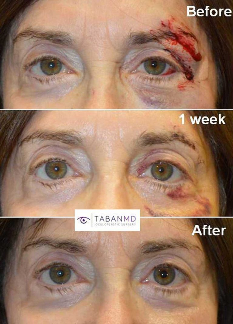Eyelid Laceration Surgery by Beverly Hills Plastic Surgeon