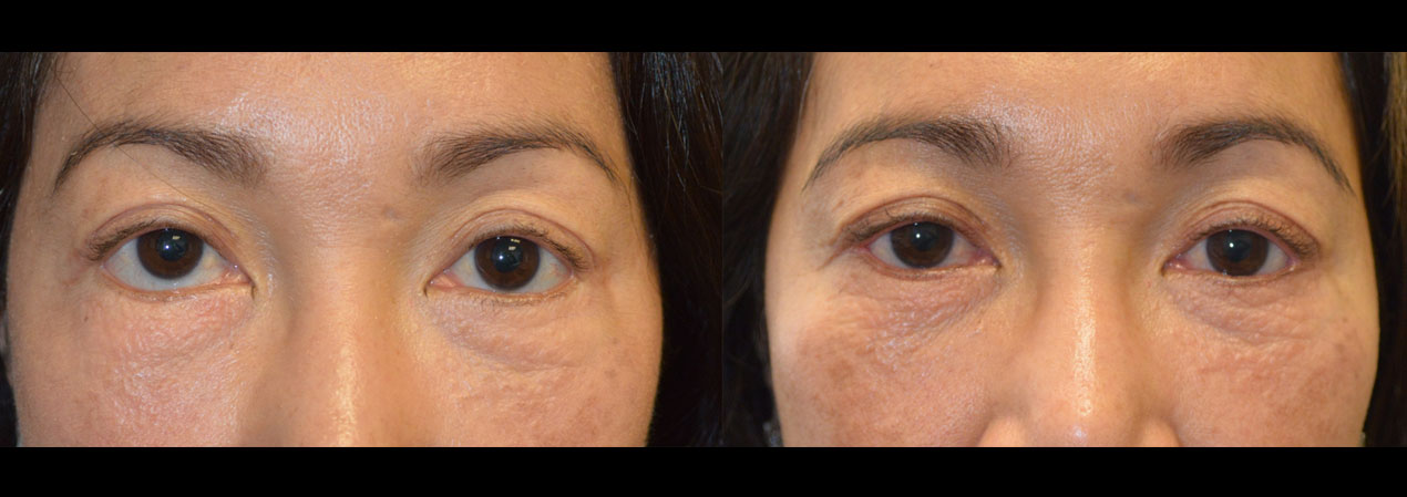46 year old Asian female, with lower eyelid retraction after previous transcutaneous lower blepharoplasty, underwent revision eyelid surgery to raise the lower eyelids (lower eyelid retraction surgery) using internal eyelid approach with soof lift and internal alloderm graft and canthoplasty. Before and 5 months after oculoplastic surgery photos are shown.