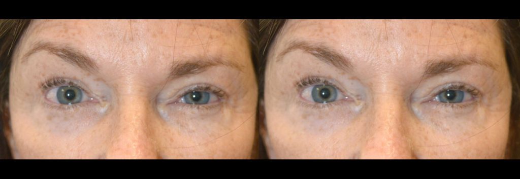 Eye Asymmetry Surgery and Treatment | Fix Uneven Eyes