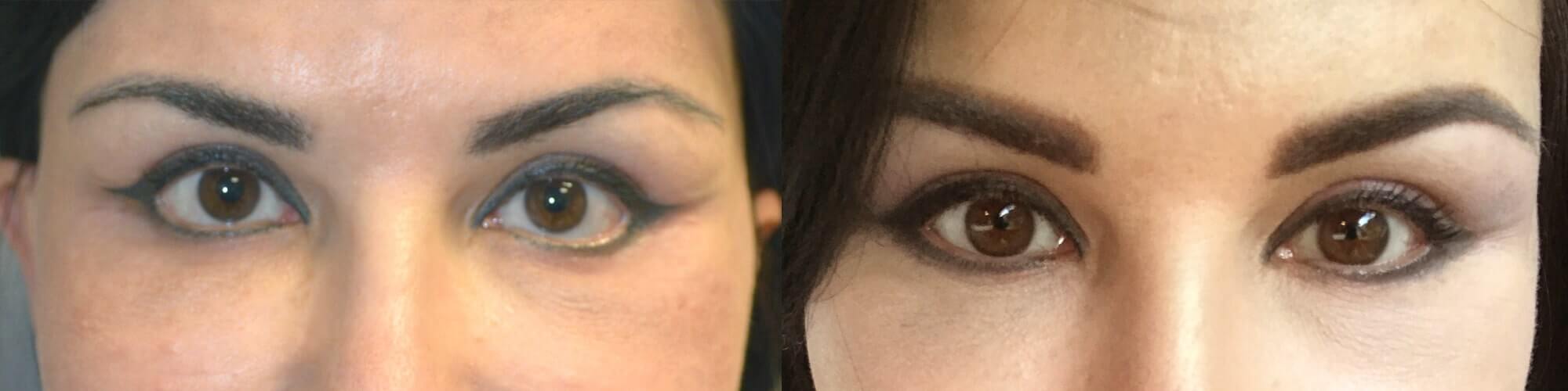 47 year old Russian female, with post-blepharoplasty lower eyelid retraction and sclera show and rounded eyes, underwent revision eyelid surgery with lower eyelid retraction surgery (internal eyelid lift, alloderm spacer graft, canthoplasty) to restore almond eye shape. Before and 3 months after lower eyelid retraction repair photos are shown.