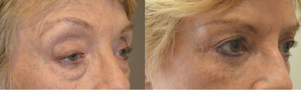 73 year old female, with eyelid aging, underwent droopy upper eyelid ptosis surgery, upper blepharoplasty, lower blepharoplasty (transconjunctival with fat repositioning and skin pinch) and lateral pretrichial brow lift, under conscious sedation. Before and 3 months after eyelid surgery photos are shown.