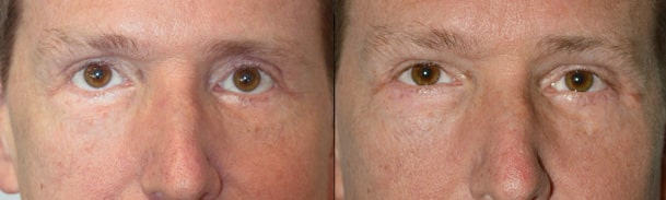 Before (left) Lower eyelid retraction after previous aggressive lower blepharoplasty and 3 months after (right photo) revisional lower eyelid retraction surgery with midface lift, internal graft, and canthoplasty. Note the eyes are more almond shaped.