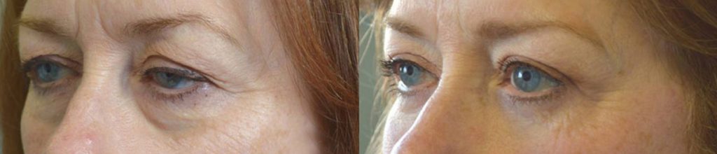 Upper Blepharoplasty Beverly Hills | Eyelid Lift Los Angeles