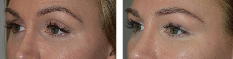 Young female, with hollowness around eyes with sunken eye appearance (left photo). Belotero filler injection in upper eyelids, brows, and under eyes (tear trough deformity) to give more youthful, rested eyes with natural results (right photo).
