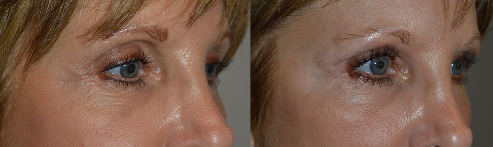 Before and immediately after FILLER (Belotero) injection in both upper eyelids to correct significant upper eyelid hollowness after prior upper blepharoplasty in a 59-year-old female.