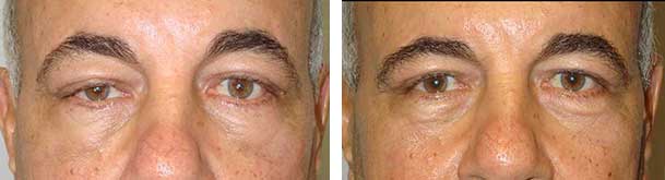 Before and after persistent right upper eyelid ptosis after previous ptosis operation.