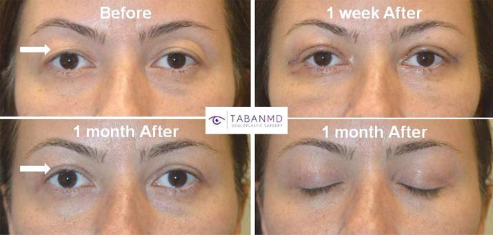 upper-eyelidYoung woman, with hooded saggy loose upper eyelid skin underwent upper blepharoplasty. Before, 1 week after, and 1 month after surgery results are shown.