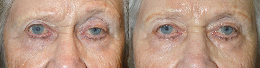 Before (left) 87 year old female, with persistent left upper eyelid ptosis after previous droopy eyelid surgery. After (right) 3 months after revision left upper eyelid ptosis surgery.
