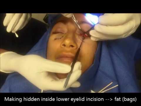 Patient Testimonial – Izabelle – Lower Blepharoplasty (Lower Eyelid Surgery) For Eye Bag Removal