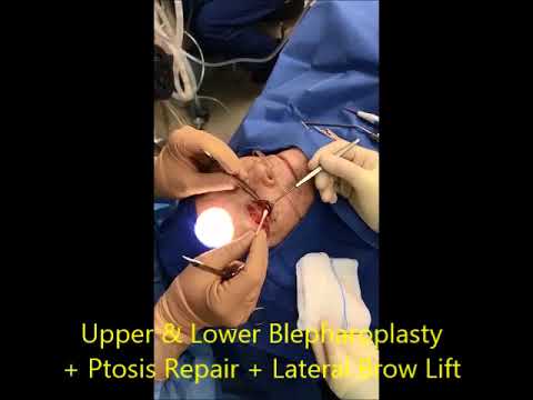 Upper and Lower Blepharoplasty with Ptosis Repair