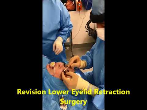 Revision Lower Eyelid Retraction Surgery