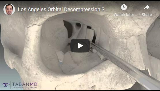 Los Angeles Orbital Decompression Surgery