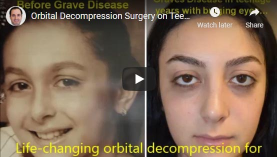 Orbital Decompression Surgery on Teenager with Graves Disease Bulging Eyes