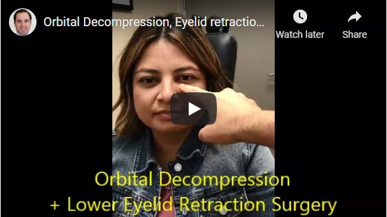 Orbital Decompression, Eyelid retraction Surgery for Graves Eye Disease