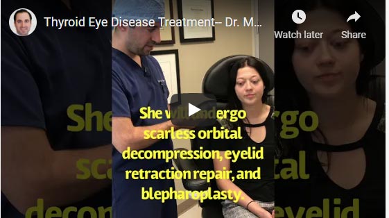 Young beautiful woman with severe Grave thyroid eye disease traveled from Slovakia to Los Angeles and underwent life-changing treatment including scarless orbital decompression surgery, lower eyelid retraction surgery, and upper blepharoplasty, to restore more natural eye shape and function. Before and 3 months after surgery results are shown.