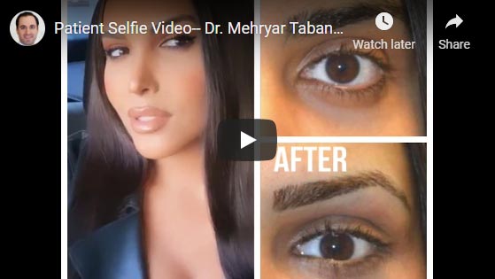 Video selfie of a happy transgender woman who underwent almond eye surgery with lower eyelid retraction surgery and canthoplasty, customized infraorbital rim silicone implant, customized orbital decompression, and upper eyelid filler.