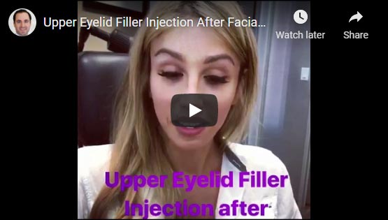 Video: beautiful transgender female undergoes upper eyelid filler injection to treat sunken hollow upper eyelids.