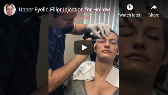 Young woman undergoes upper eyelid filler injection to treat hollowness that resulted from aggressive upper blepharoplasty.