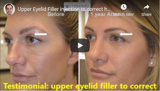 Young woman underwent upper eyelid filler injection to correct hollowness caused by previous aggressive upper blepharoplasty (by another surgeon). She returns over one year after filler injection and still happy.