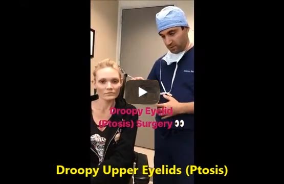 Droopy Eyelid Surgery