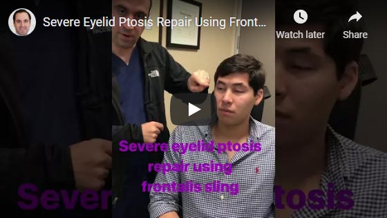 Video of young man who came from Ecuador to have frontalis sling surgery for severe congenital droopy upper eyelids (ptosis).