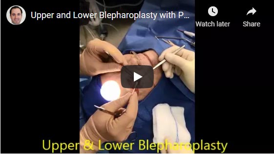 Video: 70+ year old woman, undergoes upper blepharoplasty, lower blepharolasty, eyelid ptosis surgery, and lateral brow lift.
