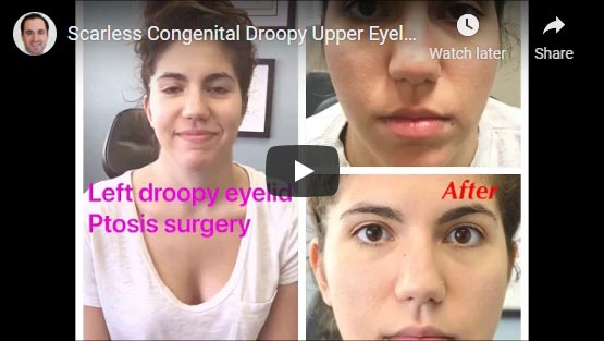 Young woman, with history of congenital left upper eyelid ptosis underwent scarless droopy upper eyelid ptosis surgery.