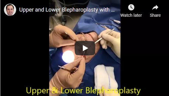 Upper and Lower Blepharoplasty with Ptosis Repair in older patient