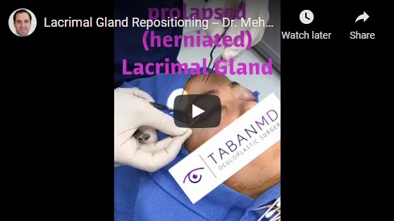 Lacrimal Gland Repositioning -- Dr. Mehryar Taban