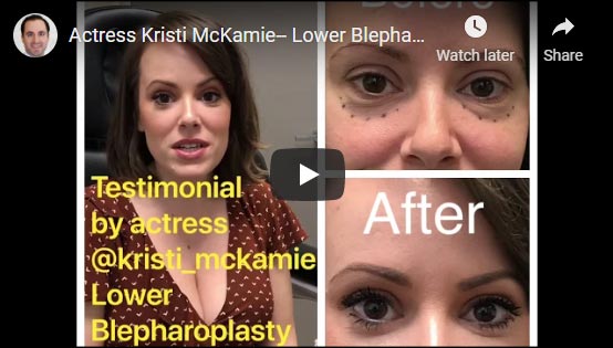 Actress Kristi McKamie Lower Blepharoplasty Testimonial -Dr. Mehryar Taban