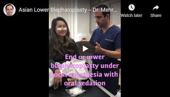 Asian Lower Blepharoplasty -- Dr. Mehryar Taban
