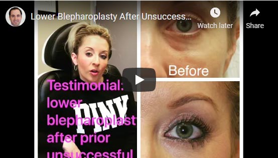 Video: Talented guitarist from Las Vegas talks about her experience with lower blepharoplasty after unsuccessful under eye filler injection.