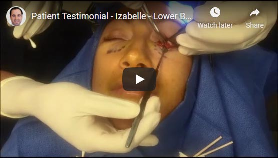 Video showing removal of hyaluronic acid gel filler clumps during transconjunctival lower blepharoplasty. Although usually possible to remove under eye filler using hyaluronidaze, sometimes filler clumps can remain.