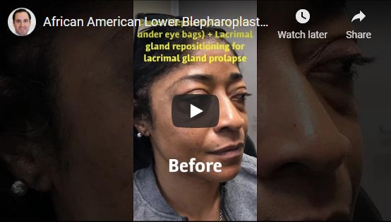 42 year old African American woman, underwent scarless lower blepharoplasty (transconjunctival technique with under eye fat bags repositioning) plus lacrimal gland repositioning.