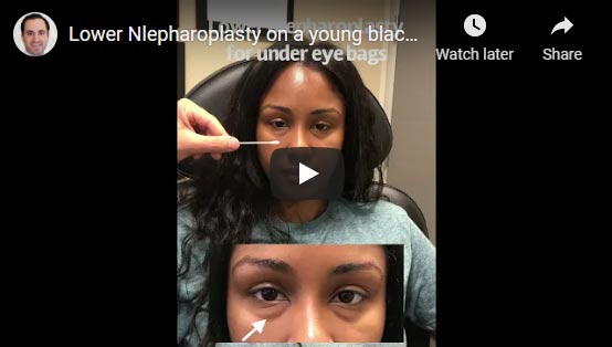 Young beautiful woman underwent scarless lower blepharoplasty (transconjunctival technique with fat repositioning) to improve genetic under eye fat bags.