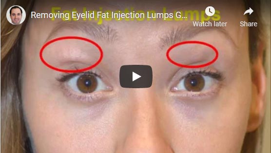 Young mother and model, underwent upper eyelid fat lumps removal (plus upper blepharoplasty) that had resulted from prior fat injection (fat transfer) by another surgeon.