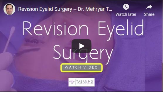 47 year old female, undergoes revision lower eyelid surgery by Dr Taban using scarless technique to remove under eye fat lumps or fat granulomas from prior under eye fat injection (by another surgeon) which was initially done to correct dark circles under eyes due to hollowness.