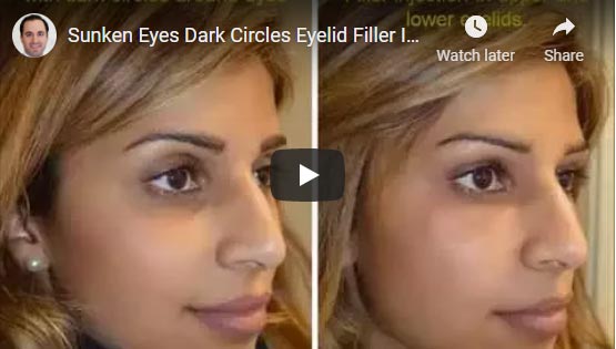 Video showing filler injection in upper eyelid and under eyes in this young woman with sunken hollow eyes and dark circles.