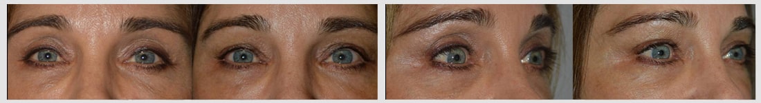 Before (left) Middle age woman with upper eyelid hollowness and sunken eyes after blepharoplasty. After (right) after upper eyelid-brow filler (Belotero) injection. Note more youthful appearance.