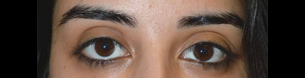 Eye Asymmetry Surgery and Treatment Fix Uneven Eyes