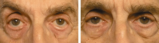 Outward Eyelid Treatment in Los Angeles