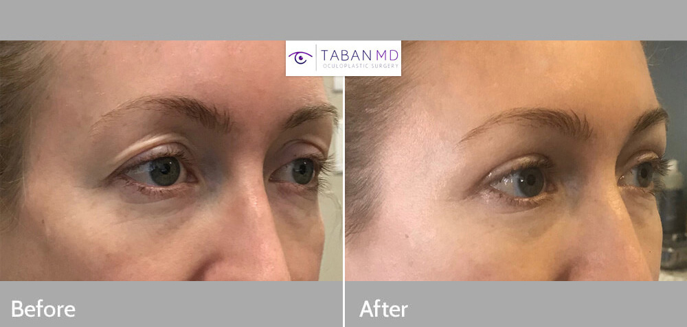Young beautiful woman with loose upper eyelid skin and upper eyelid deflation and hollowness due to fat loss, underwent combined upper blepharoplasty and upper eyelid filler injection. Note more youthful rested eye appearance.