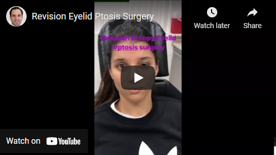 Revision Eyelid Ptosis Surgery Video