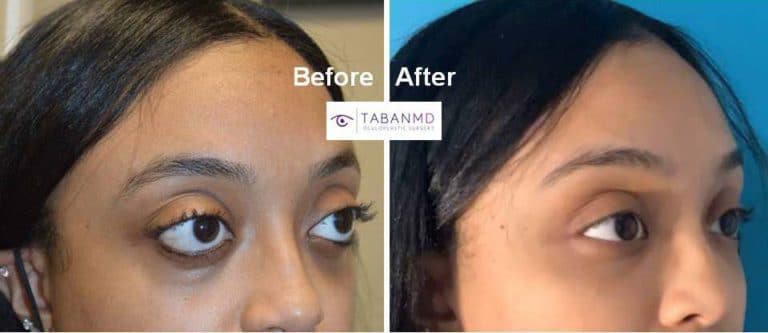 Young woman underwent life changing eye plastic surgery (cosmetic orbital decompression, lower eyelid retraction surgery with canthoplasty, infraorbital rim implant, and upper eyelid filler injection) to improve her eye appearance.