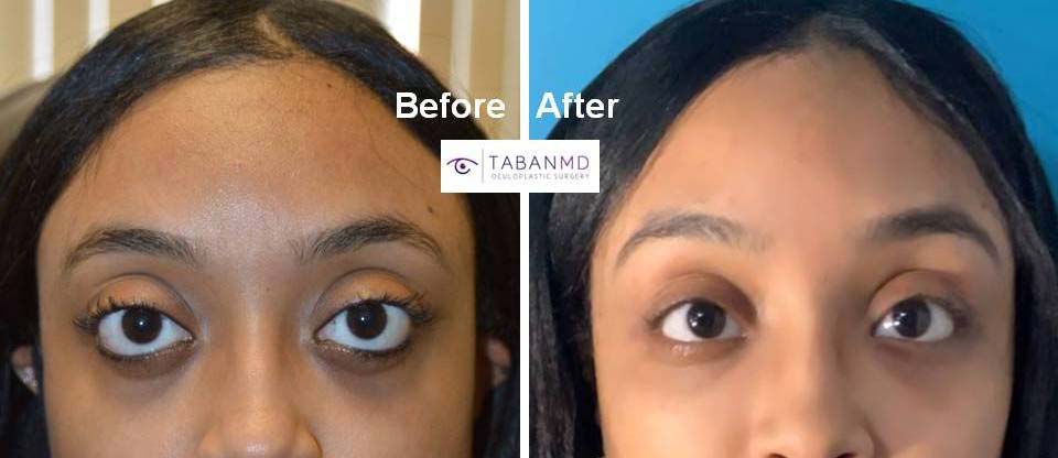 Young woman underwent life changing eye plastic surgery (cosmetic orbital decompression, lower eyelid retraction surgery with canthoplasty, infraorbital rim implant, and upper eyelid filler injection) to improve her eye appearance.