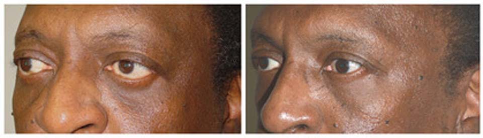 Middle age male, with thyroid eye disease, who underwent eye socket surgery followed later by lower eyelid retraction surgery and canthoplasty.