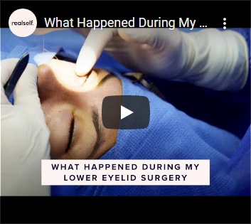 What Happened During My Lower Eyelid Surgery | In the OR (Part 2 of 3)
